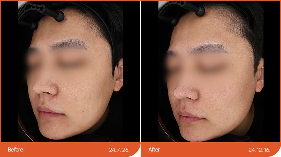 울쎄라 before/after 1