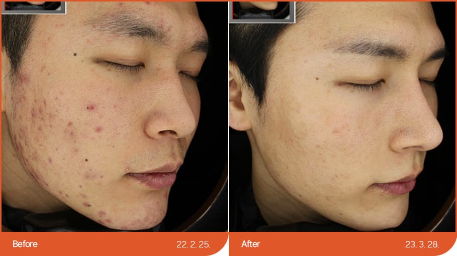 ニキビ・ニキビ跡 before/after 1