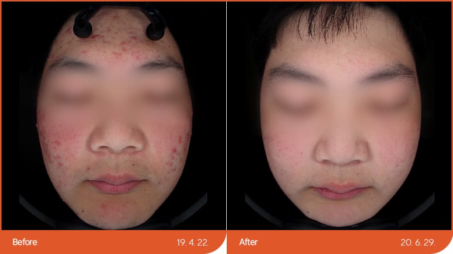 痤瘡/疤痕治療
