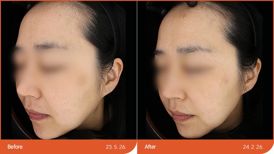 シミ・そばかす・肝斑 before/after 1