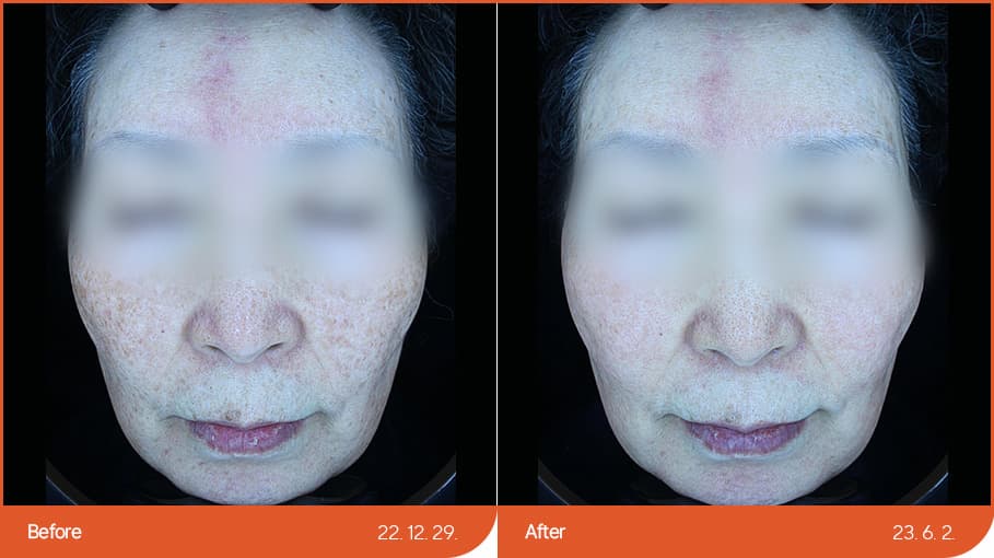 色素性疾病治療