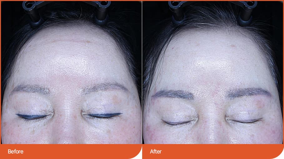 纹身去除 before/after 1