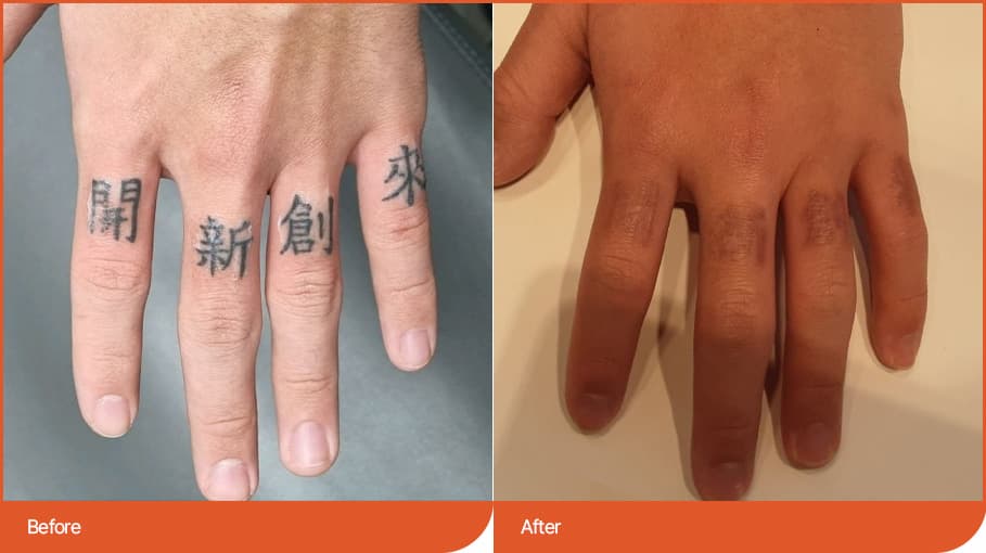 紋身去除