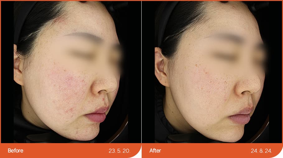 홍조 before/after 1