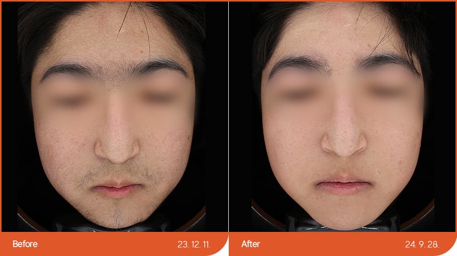 제모교정 before/after 1