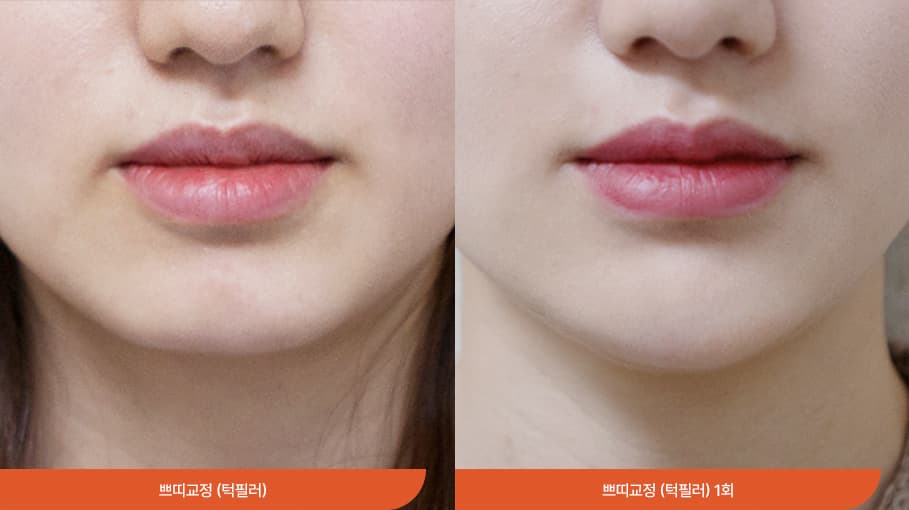 フェイスライン注射 before/after 1