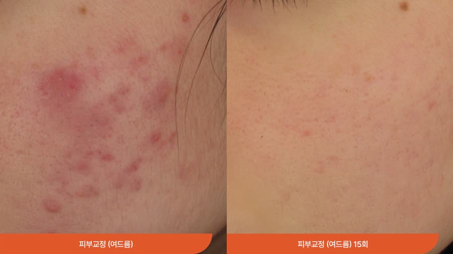 민감성 피부 before/after 1