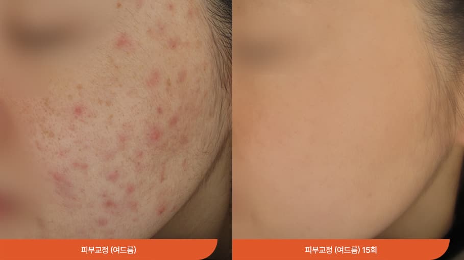 敏感性皮膚治療